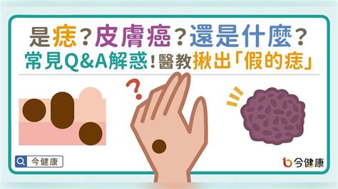 為甚麼會長痣|是痣？皮膚癌？還是什麼？常見Q&A解惑！醫教揪出「。